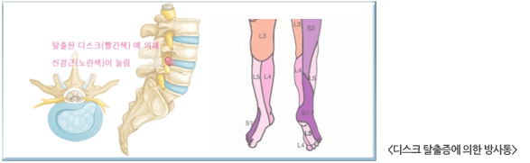 디스크 탈출증에 의한 방사통